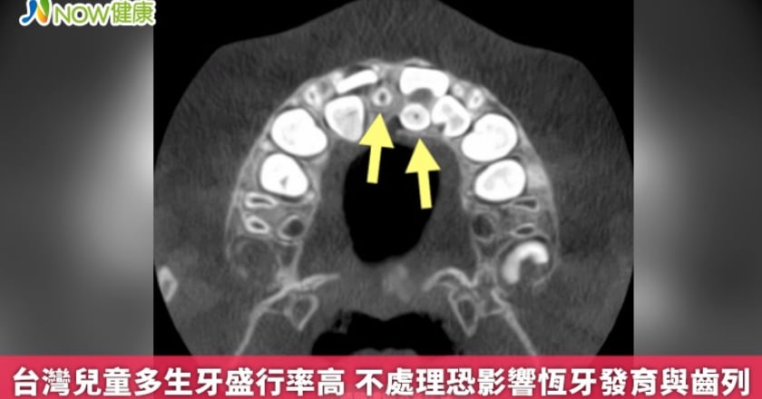 台灣兒童多生牙盛行率高 不處理恐影響恆牙發育與齒列
