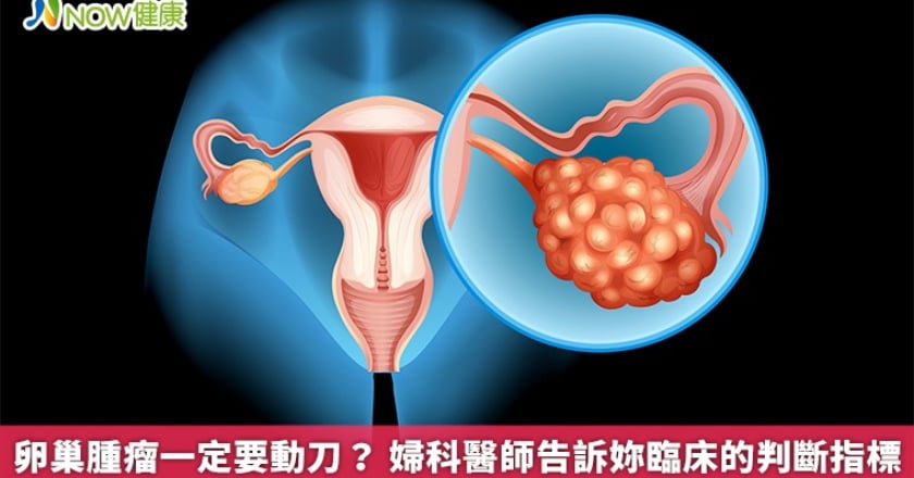 卵巢腫瘤一定要動刀？ 婦科醫師告訴妳臨床的判斷指標