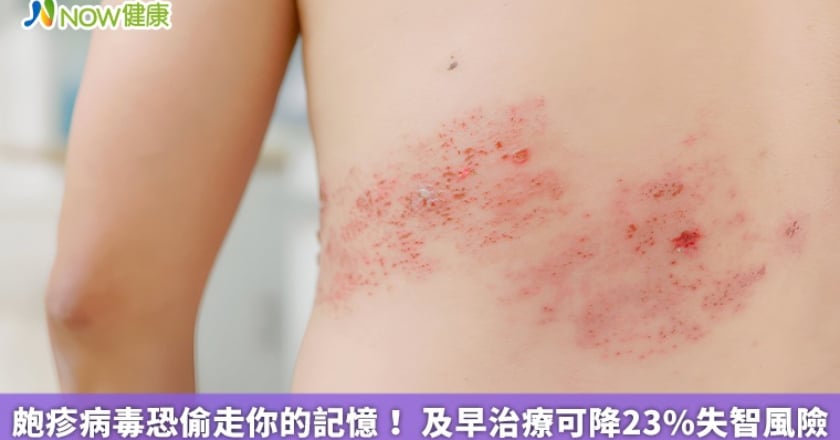 皰疹病毒恐偷走你的記憶！ 及早治療可降23％失智風險