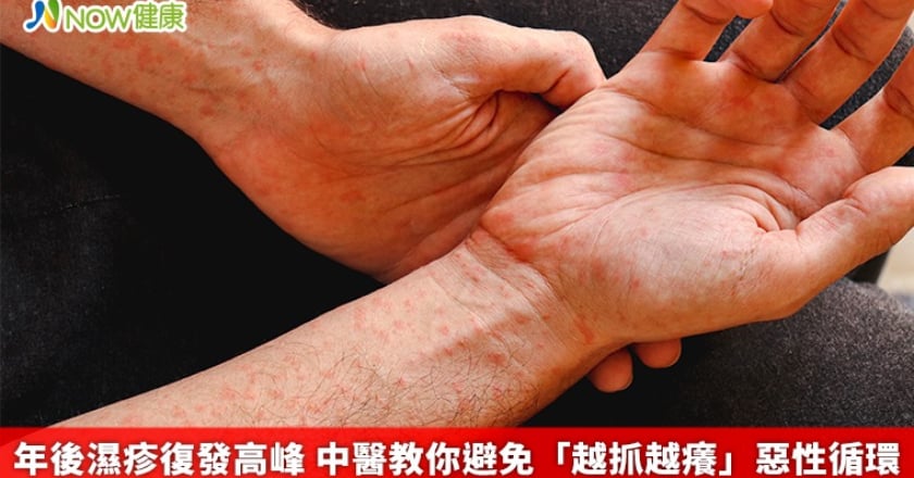 年後濕疹復發高峰 中醫教你避免「越抓越癢」惡性循環