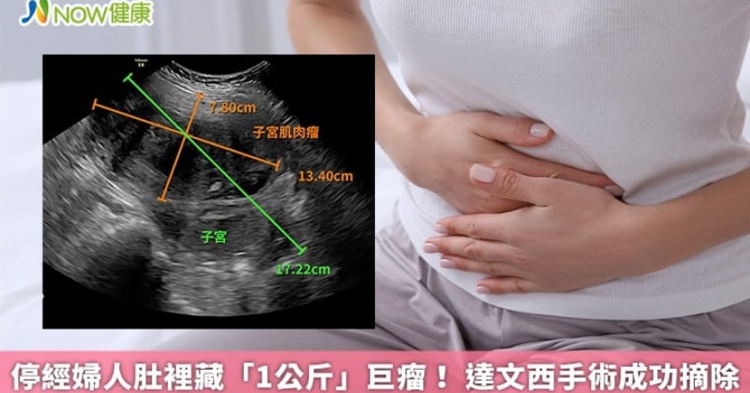 停經婦人肚裡藏「1公斤」巨瘤！ 達文西手術成功摘除