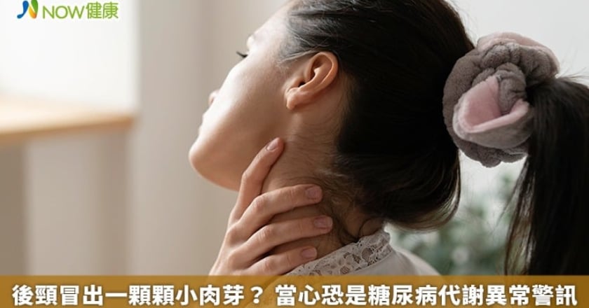 後頸冒出一顆顆小肉芽？ 當心恐是糖尿病代謝異常警訊