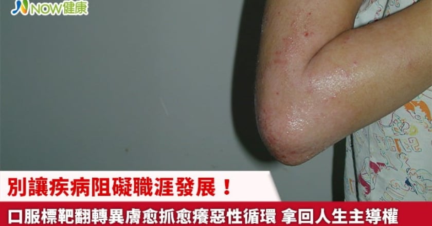 別讓疾病阻礙職涯發展！口服標靶翻轉異膚愈抓愈癢惡性循環 拿回人生主導權