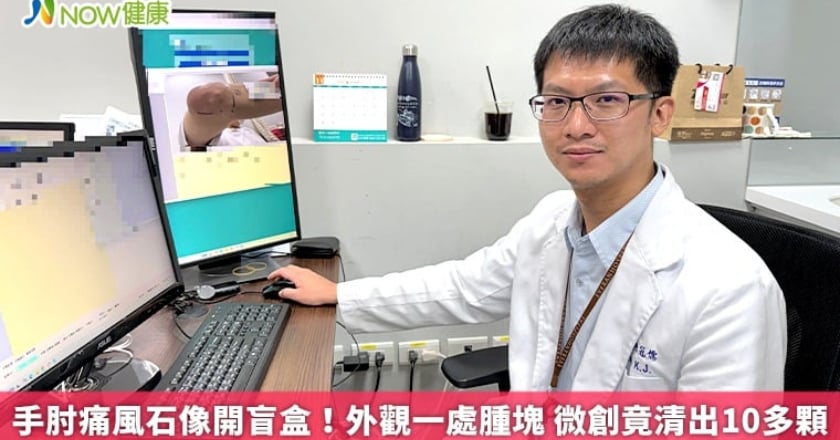 手肘痛風石像開盲盒！外觀一處腫塊 微創竟清出10多顆