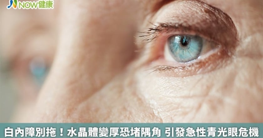 白內障別拖！水晶體變厚恐堵隅角 引發急性青光眼危機