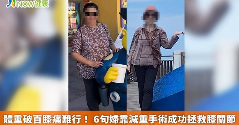 體重破百膝痛難行! 6旬婦靠減重手術成功拯救膝關節