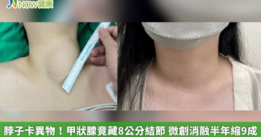 脖子卡異物!甲狀腺竟藏8公分結節 微創消融半年縮9成