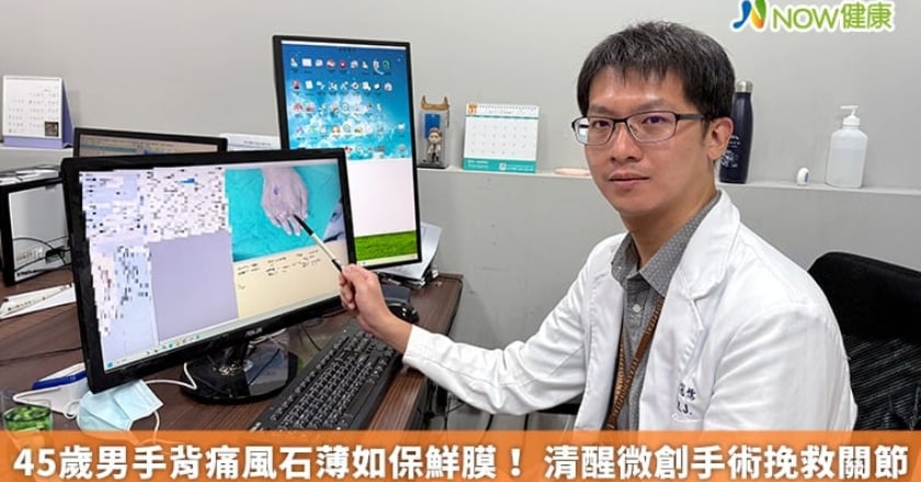 45歲男手背痛風石薄如保鮮膜！ 清醒微創手術挽救關節