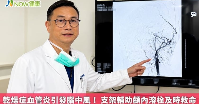 乾燥症血管炎引發腦中風! 支架輔助顱內溶栓及時救命