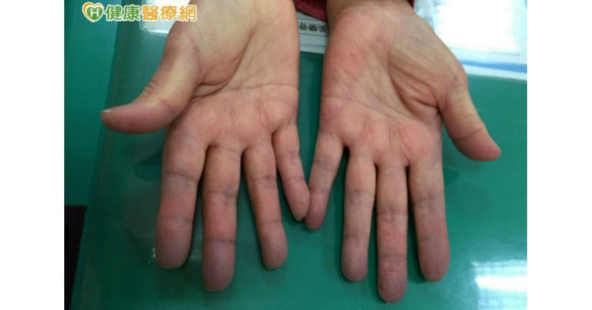 天冷手指變藍紫色　當心是雷諾氏現象
