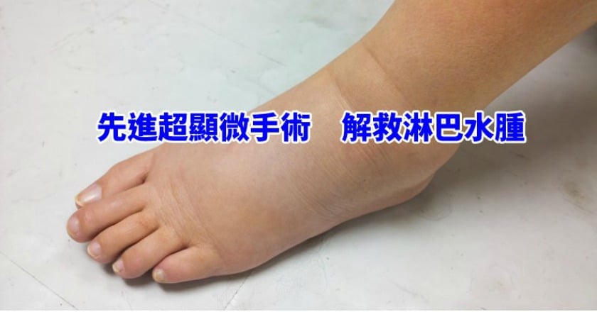 淋巴液外滲、全身飄惡臭　「淋巴水腫」讓他比罹癌更苦