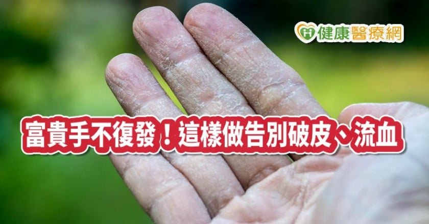 富貴手不再復發關鍵! 三點預防觀念告別破皮、流血