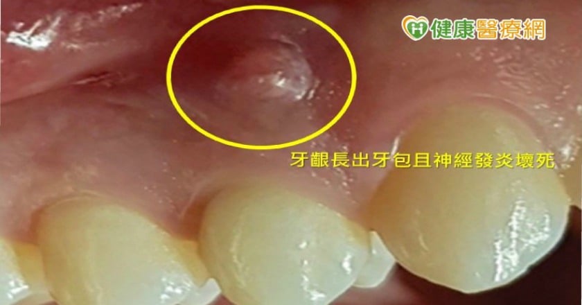 別以為牙齒抽過神經就沒事！　２原因都需要再治療