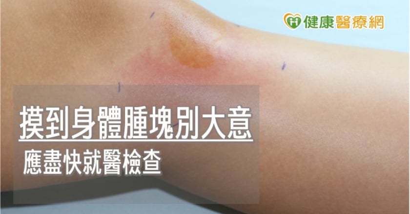 惡性肉瘤初期無感　出現痛覺恐已成癌
