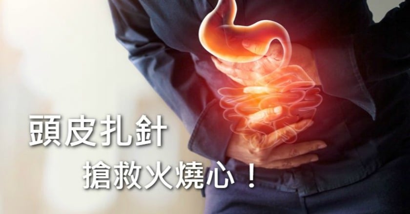 火燒心不見了! 「一根針」治好胃食道逆流