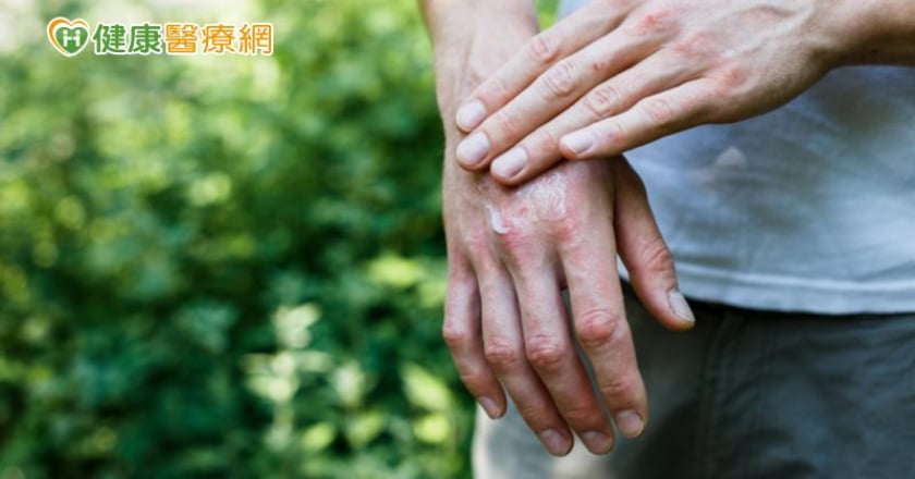 疫情期間乾癬如何控制？　生物製劑助化「癬」為夷！