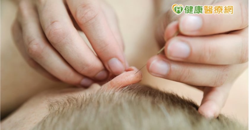 癮君子戒菸好難？　中醫耳穴針灸助抑制菸癮