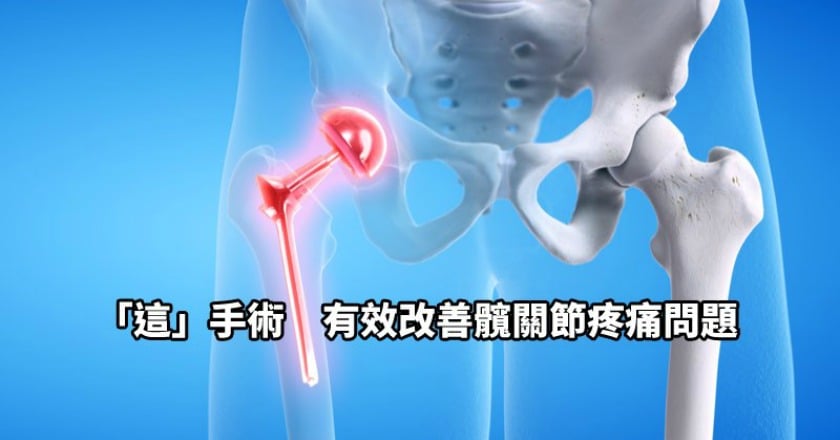 微創手術治療髖關節疼痛 傷口小恢復快