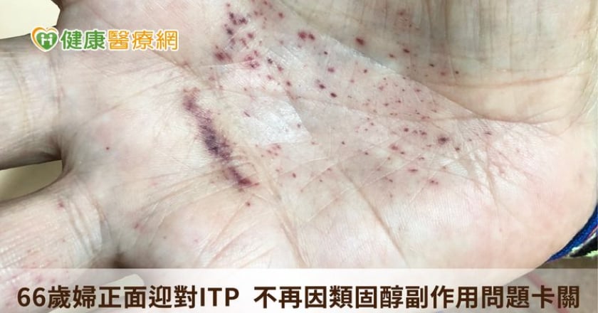66歲婦正面迎對ITP　不再因類固醇副作用問題卡關