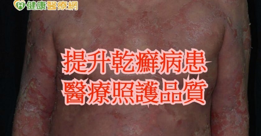 洗澡如廁彷彿火燒皮 重視乾癬病患照護