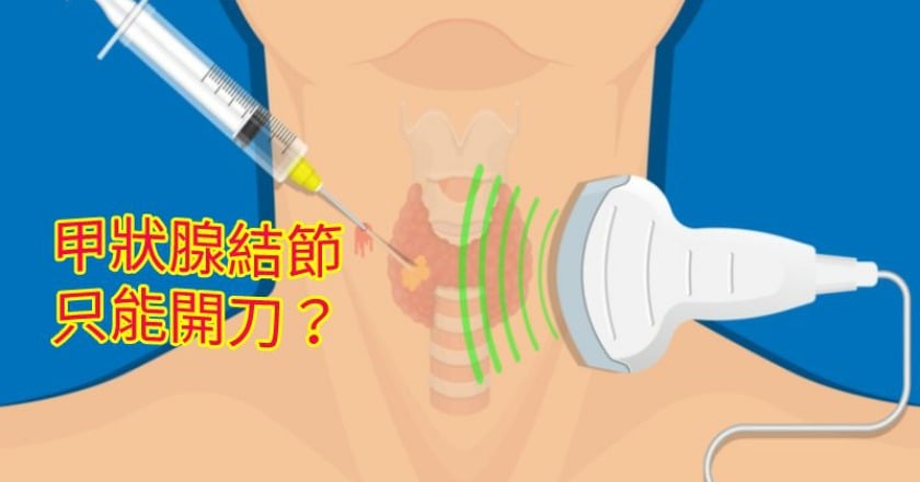 治療甲狀腺結節　唯一方法只有開刀？