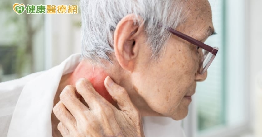 皮膚不癢不痛脫屑 就醫竟是「癌」!