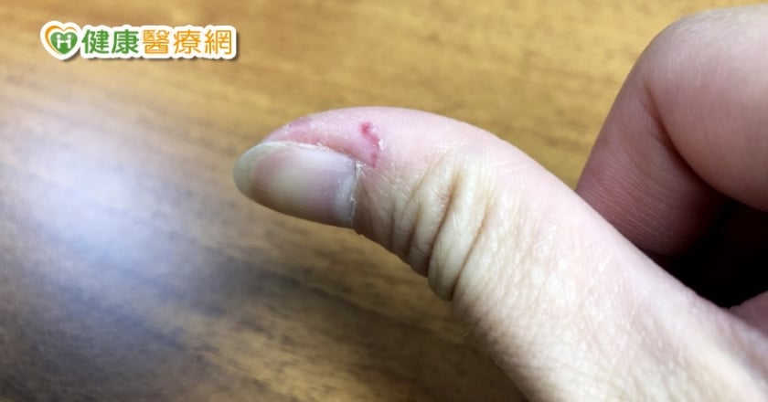指甲旁邊倒刺 居然跟新冠疫情有關?