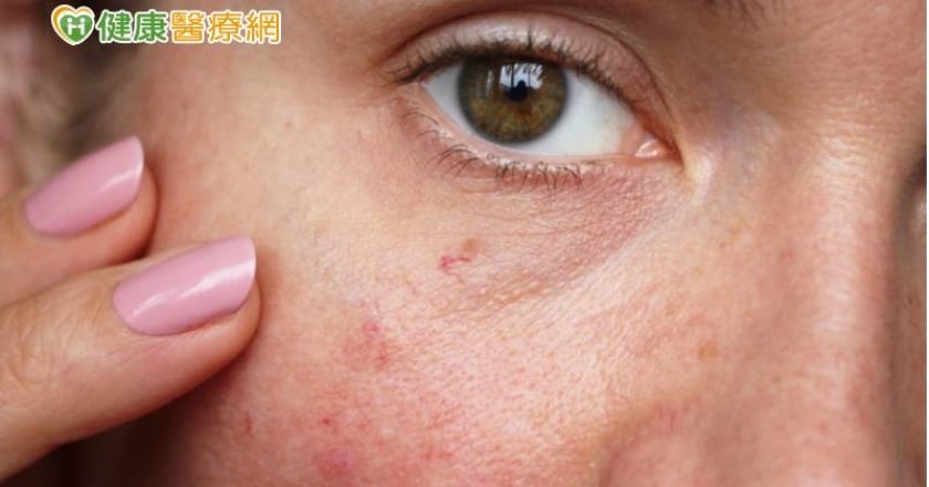 以為蟲咬竟變血管瘤！　醫揭「超不尋常症狀」快就醫