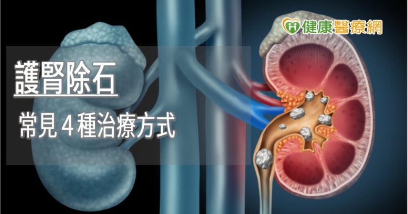 治療複雜性腎結石 常見手術優缺點一張圖看懂