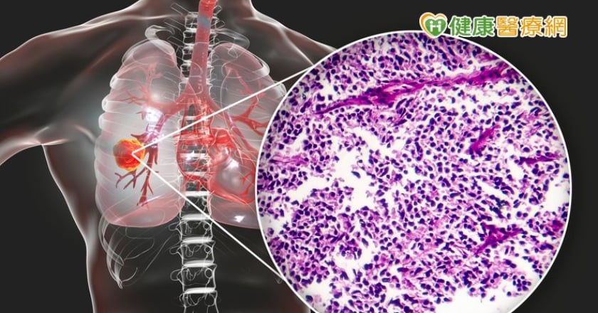 曾1個月內全身佈滿腫瘤　小細胞肺癌患者靠「這個」延命