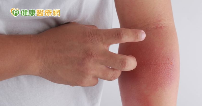疫情引憂心！異位性皮膚炎能施打新冠疫苗嗎？