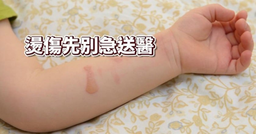 先沖脫泡30分鐘 燙傷送醫前一定要做這件事