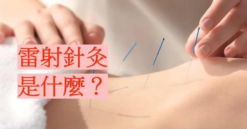 雷射針灸療法 避免煙味和燙傷風險