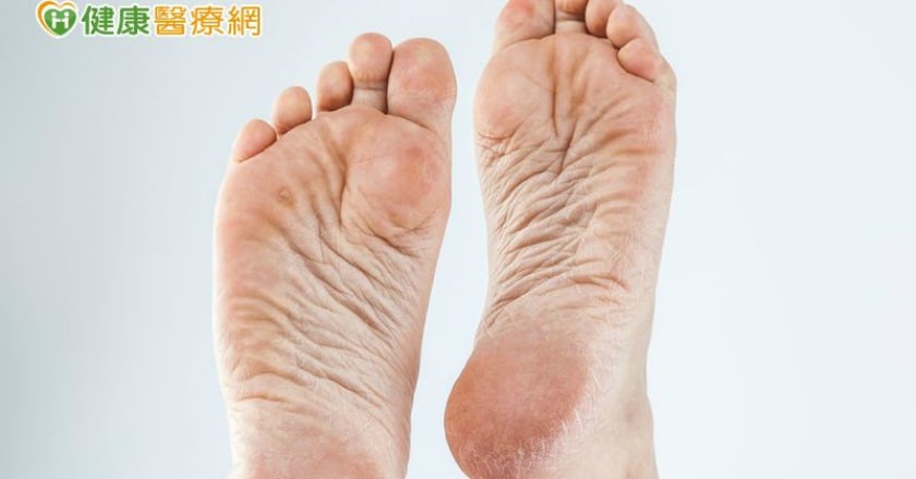 腳底黑斑冒不停？　當心與這種癌有關