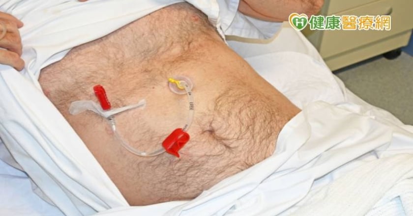 捨棄鼻胃管 七旬嬤從「這」找回尊嚴!