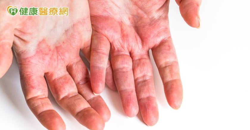 大腸癌患者福音!補充鋅竟能減少標靶藥「手足皮膚反應」 提升治療效果