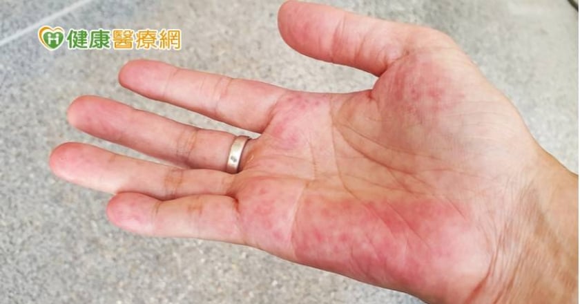 大林慈院為紅斑性狼瘡開創 「系統性整合照護模式」獲SNQ認證
