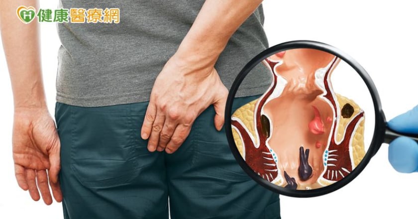 現代人文明病！痔瘡保守治療無效怎辦？ 「3種手術」選擇看這