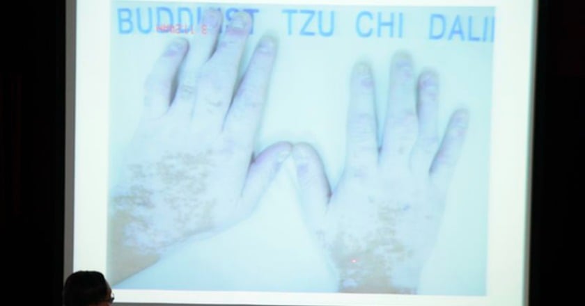 白斑沒藥醫？　逾九成病患免疫療法獲控制