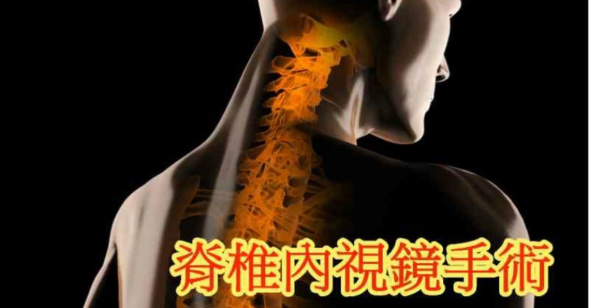 脊椎內視鏡手術　降低癱瘓風險