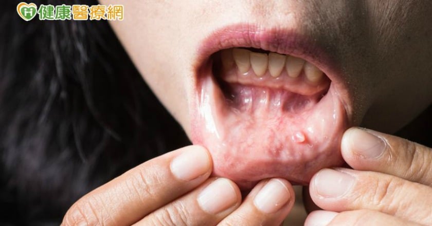 口腔癌徵兆不痛不癢　4成拖到晚期