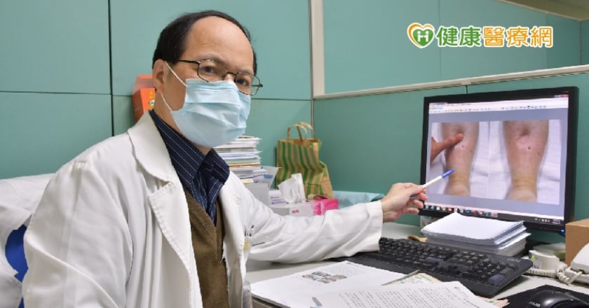 下肢水腫恐是重症警訊！　「6疾病」嚴重會立即奪命
