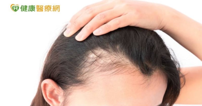 「雄性禿」不只男性有！　醫揪：恐怕是「這些原因」惹禍