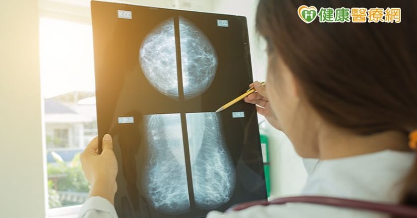 乳房有良性腫瘤要拿掉嗎?家族史有風險拿掉較好!