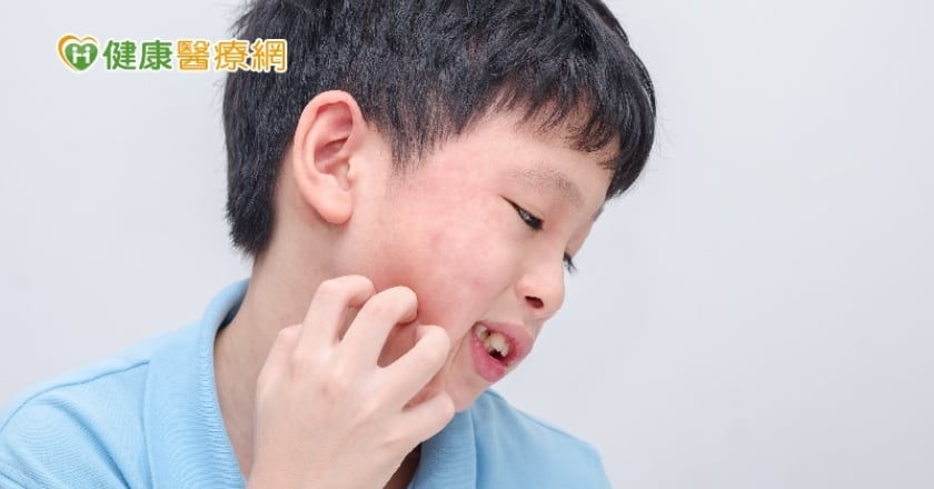 你對藥物過敏嗎？　留意6症狀「疹、破、痛、紅、腫、燒」