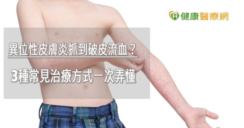 異位性皮膚炎抓到破皮流血？　3種常見治療方式一次弄懂