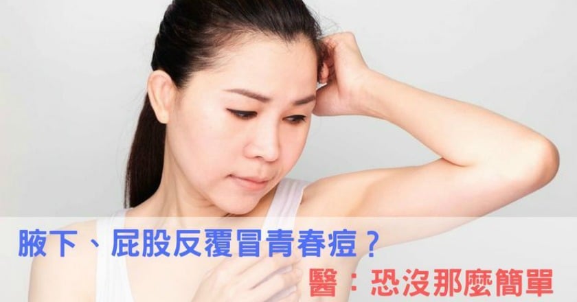 腋下、屁股反覆冒青春痘？　醫：恐沒那麼簡單