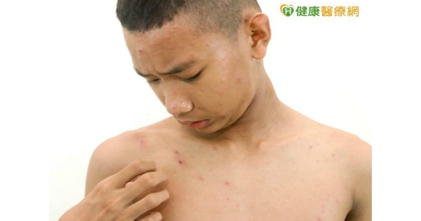 校園水痘群聚感染增　國中以上達九成