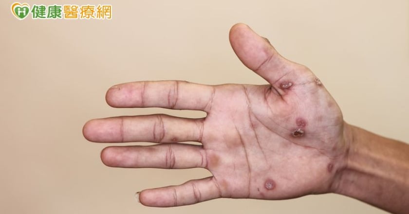 手腳紅斑不癢！他問AI竟罹「梅毒二期」 醫點頭揭成因