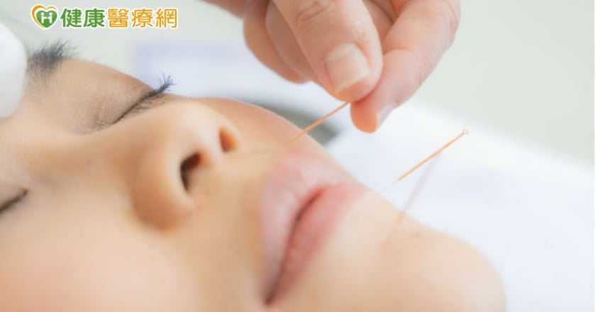 針灸改善臉部水腫　調節水氣助代謝